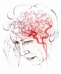 Brain blood supply in elderly woman with vascular dementia