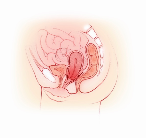 Cross section of female reproductive system showing prolapse of the uterus